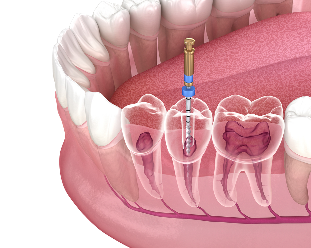 Ramsey Endodontics root canal treatment process. Medically accurate tooth 3D illustration.
