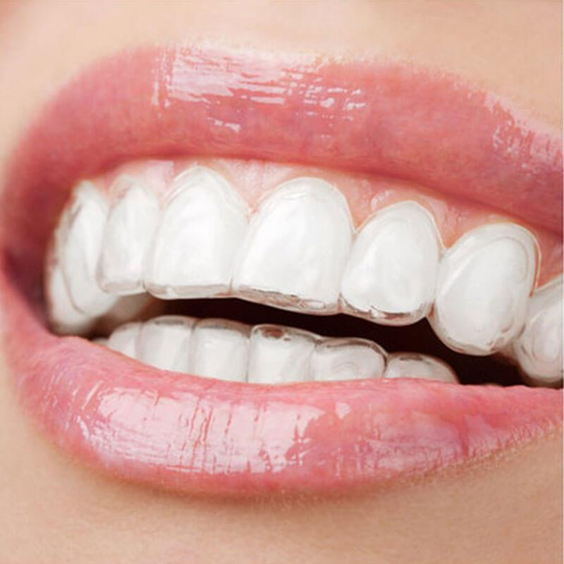 Clear braces for adults | Modern Orthodontic Solutions