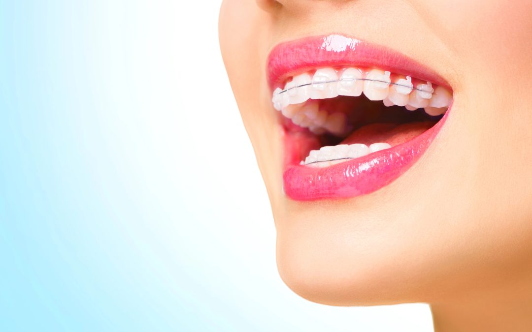 Invisalign or braces | Find the Best Choice