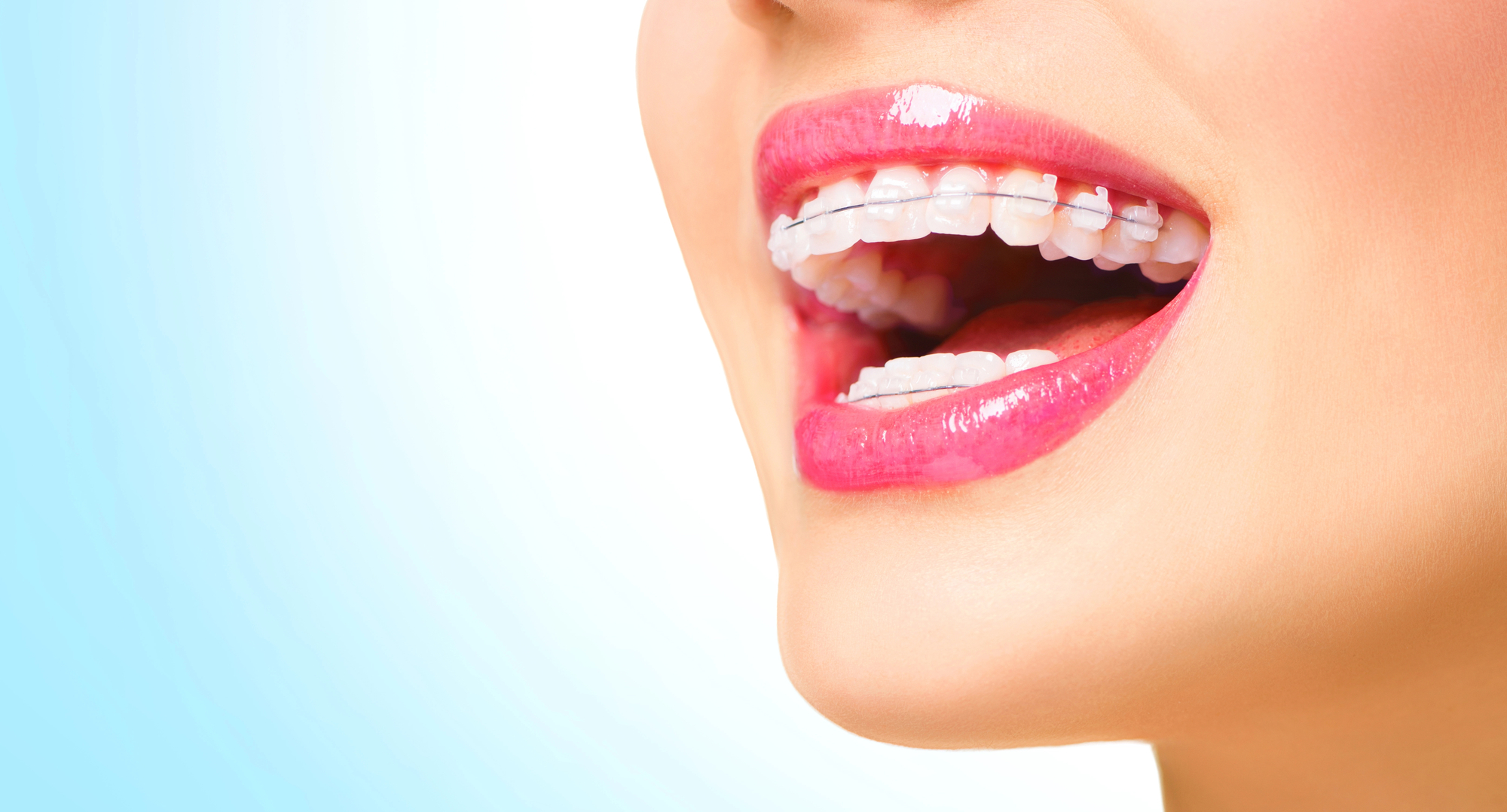 Invisalign or braces | Find the Best Choice