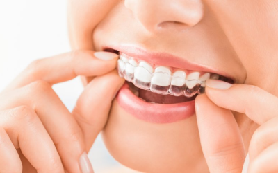 How long does Invisalign take | Treatment Timelines