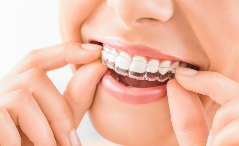 How long does Invisalign take | Treatment Timelines